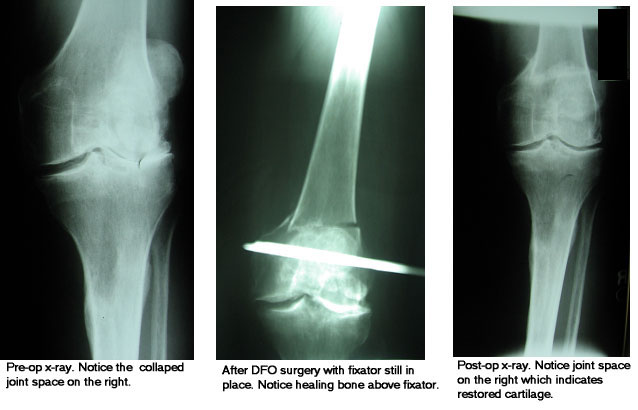 Images of DFO pre and post surgery