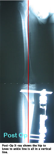 This X-ray shows the entire leg after surgery. Notice the vertical line made by the hip to knee to ankle. Standing X-ray post-op