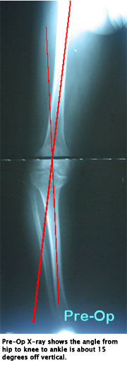 Standing X-ray pre-op