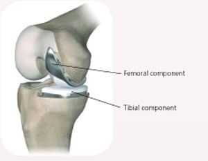 Unicompartmental knee replacement